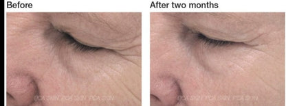 Before and after using PCA Skin ExLinea Peptide Smoothing Serum for two months, showing reduced forehead wrinkles