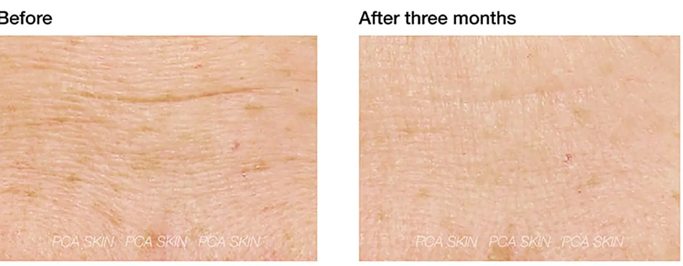 Before and after 3 months using PCA Skin ExLinea Peptide Smoothing Serum, showing visible skin texture improvements