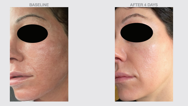 Before and after 4 days using Phyto Balance Serum, showing smoother skin and reduced redness