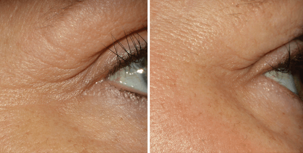 Alastin restorative eye deals treatment