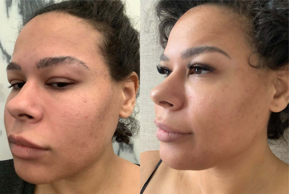 Before and after results using Revision Skincare C+ Correcting Complex 30% showing brighter smoother skin tone
