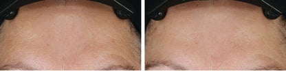 Before and after forehead skin texture results using Revision Skincare D·E·J Face Cream for smoother hydrated-looking skin