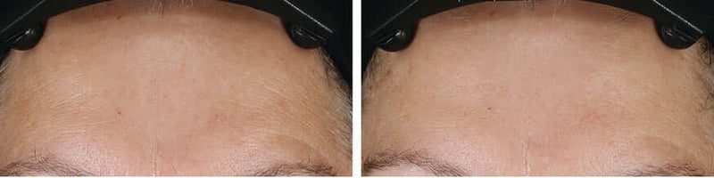 Before and after forehead skin texture results using Revision Skincare D·E·J Face Cream for smoother hydrated-looking skin