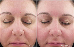 Before and after 12 weeks using Revision Skincare Intellishade Original SPF 45 showing improved skin appearance