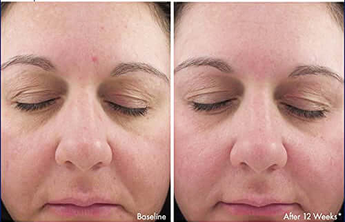 Before and after 12 weeks using Revision Skincare Intellishade Original SPF 45 showing improved skin appearance