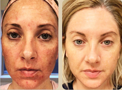 Before and after using Revision Skincare Brightening Facial Wash, results showing reduced acne and more even skin tone.