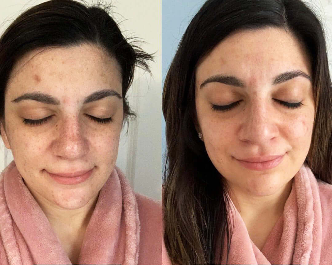 Before and after results using Revision Brightening Facial Wash showing clearer skin smoother tone and reduced spots tan and