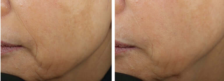 Before and after jawline smoothing results using Revision Skincare D·E·J Face Cream for improved skin texture and firmness