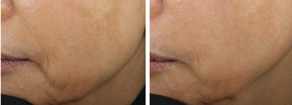 Before and after using Revision Skincare DEJ Face Cream, showing significant reduction in facial lines