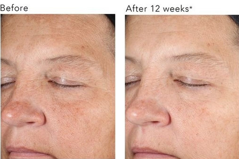 Before and after 12 weeks using Revision Skincare DEJ Night Face Cream, showing visible reduction in facial lines