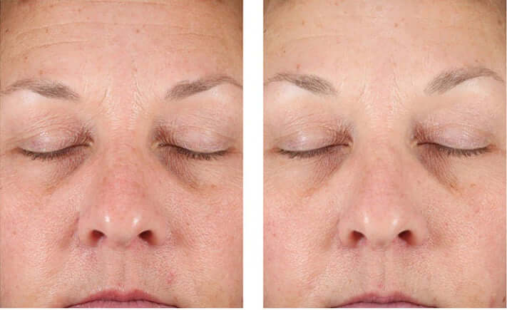 Before and after facial firmness comparison following use of Revision Skincare DEJ Night Face Cream firming night cream
