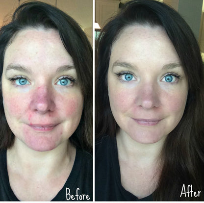 Before and after using Revision Skincare Gentle Cleansing Lotion, showing improved skin tone, reduced redness, and smoother texture