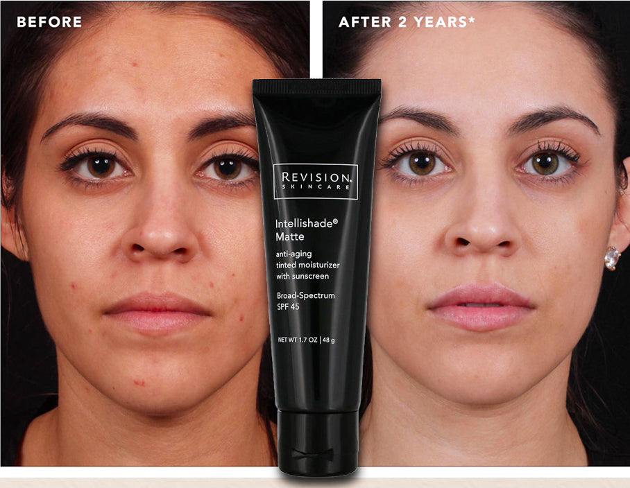 Before and after using Revision Skincare Intellishade Matte SPF 45, 2-year results showing improved skin clarity