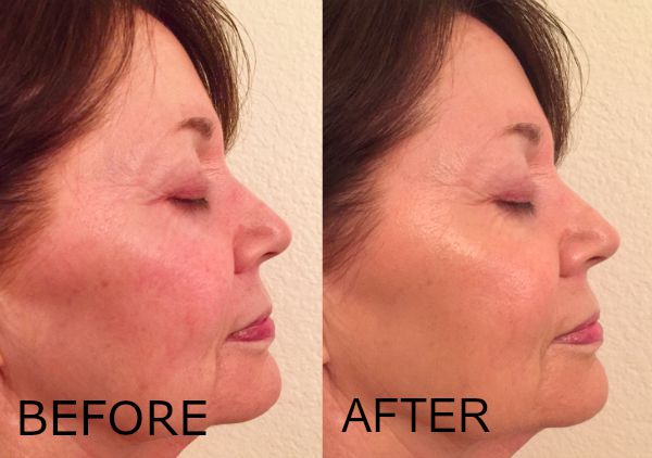 Before and after using Revision Skincare Intellishade Matte SPF 45, showing improved skin tone and texture