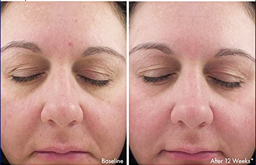 Before and after 12 weeks using Revision Skincare Intellishade Original SPF 45, showing improved skin tone and texture