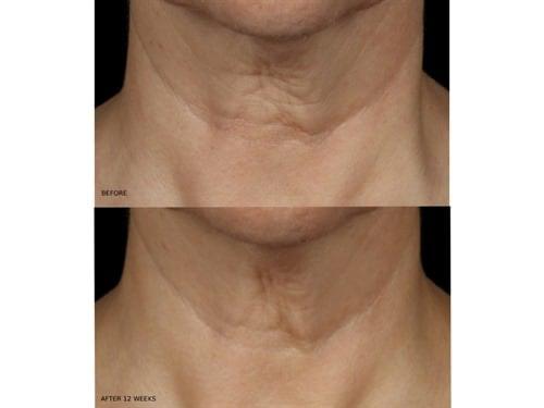 Before and after using Revision Skincare Nectifirm, 12-week results showing firmer neck skin