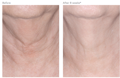 Before and after using Revision Skincare Nectifirm, 8-week results showing firmer neck skin