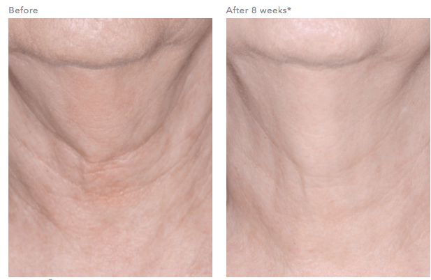 Before and after 8 weeks using Revision Skincare Nectifirm neck cream showing smoother looking neck appearance