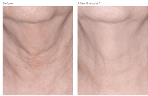 Before and after 8 weeks using Revision Skincare Nectifirm neck cream showing smoother looking neck appearance
