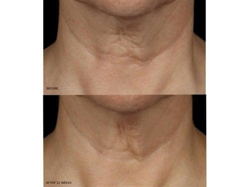 Before and after 12 weeks using Revision Skincare Nectifirm neck cream showing smoother neck appearance