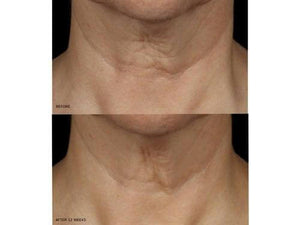 Before and after 12 weeks using Revision Skincare Nectifirm neck cream showing smoother neck appearance