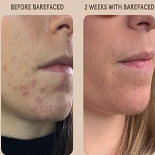 Before and after using Revision Skincare Pore Purifying Clay Mask, 2-week results showing reduced acne and clearer skin