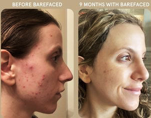 Before and after using Revision Skincare Pore Purifying Clay Mask, 9-month results showing reduced acne and clearer skin