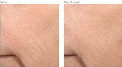 Before and after comparison of fine lines appearance following use of Revision Skincare Retinol Complete 0.5 serum