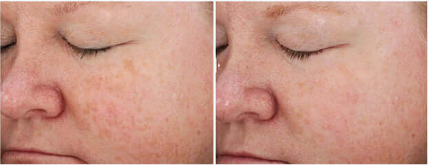 Side-by-side skin texture comparison showing improvement after using Revision Skincare Retinol Complete 0.5 serum