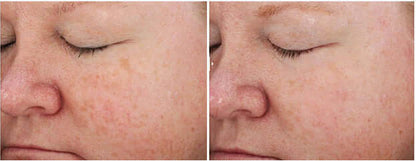 Side-by-side skin texture comparison showing improvement after using Revision Skincare Retinol Complete 0.5 serum