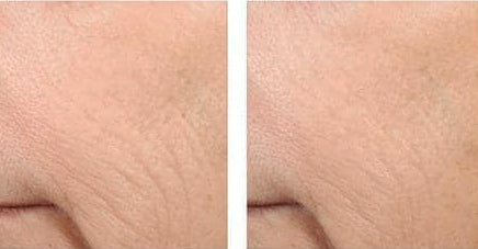 Before and after using Revision Skincare Retinol Complete 1.0, 12-week results showing reduced wrinkles and improved skin texture