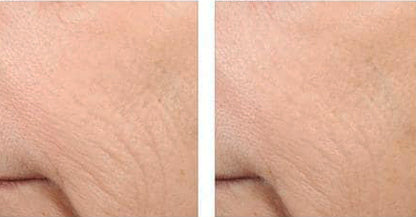 Before and after using Revision Skincare Retinol Complete 1.0, 12-week results showing reduced wrinkles and improved skin texture