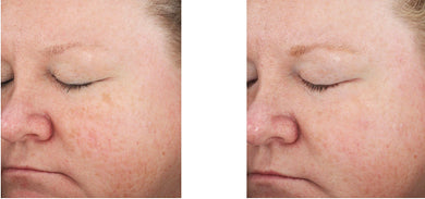 Before and after using Revision Skincare Retinol Complete 1.0, showing improved skin texture and reduced redness over time