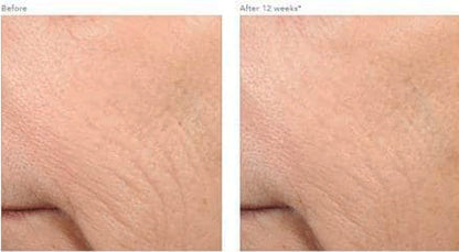 Before and after using Revision Skincare Retinol Complete 0.5, 12-week results showing reduced wrinkles and smoother skin texture