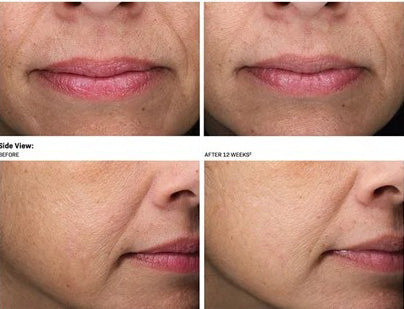 Before and after 12 weeks using Revision Skincare Revox Line Relaxer, showing significant reduction in facial lines