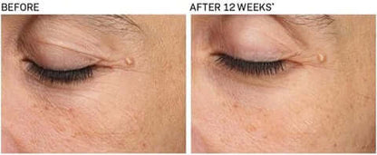 Before and after comparison showing smoother crow’s feet after using Revision Skincare Revox Line Relaxer 0.68 oz