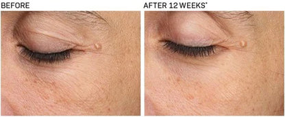 Before and after 12 weeks using Revision Skincare Revox Line Relaxer on eye area, showing noticeable reduction in Eye