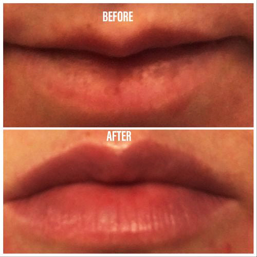 Before and after using Revision Skincare YouthFull Lip Replenisher, showing noticeable improvement in lip fullness