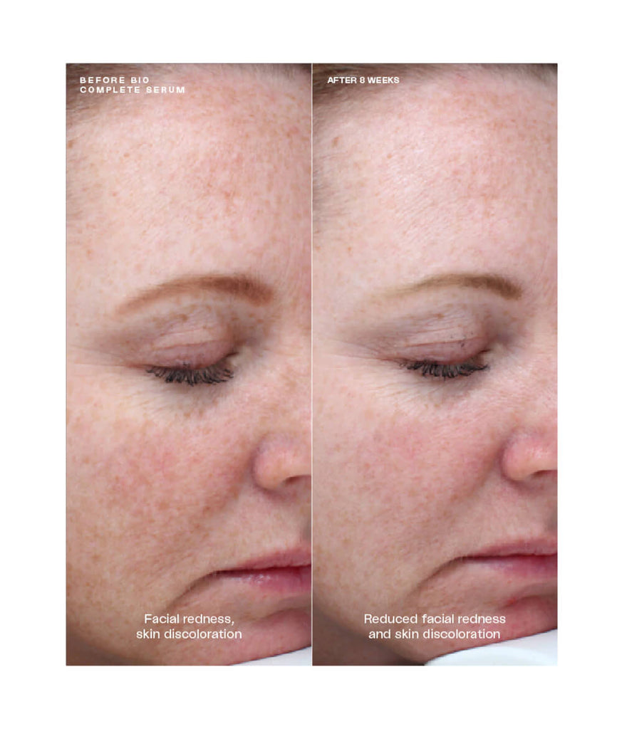 Before and after using SENTÉ Bio Complete Serum, 8-week results showing reduced facial redness and skin discoloration