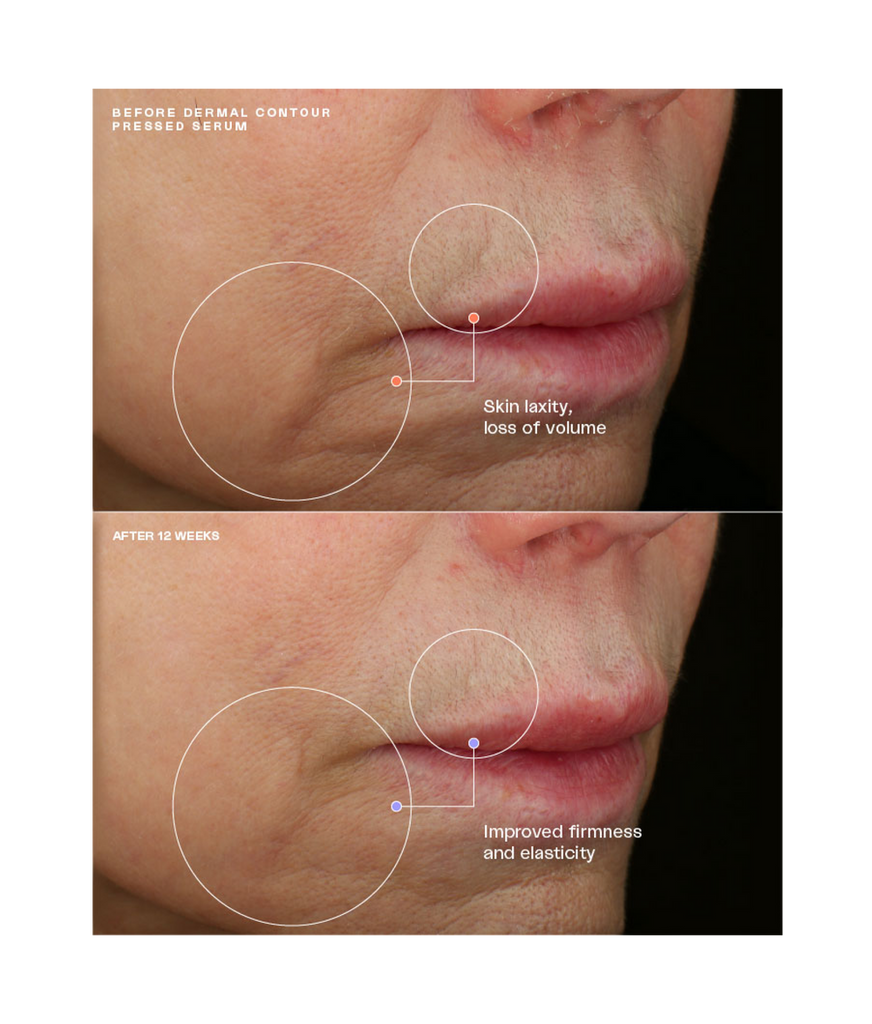 Before and after using SENTÉ Dermal Contour Pressed Serum, 12-week results showing improved skin firmness and elasticity