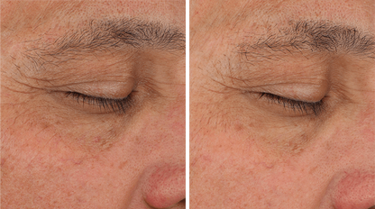 Before and after using SENTÉ Illumine Eye Cream, showing reduced fine lines and improved skin texture