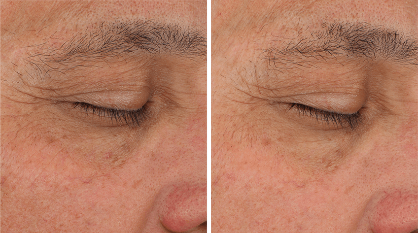 Before and after using SENTÉ Illumine Eye Cream, showing reduced fine lines and improved skin texture