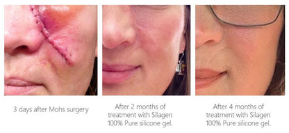 Before and after using Silagen 100% Pure Silicone Gel, showing scar reduction over 4 months after surgery