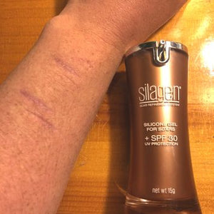 Arm scar shown beside Silagen silicone scar gel with SPF 30 (15g) bottle on wooden surface for scar protection.