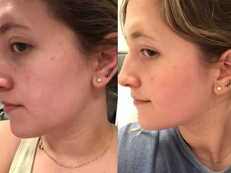 Side-by-side before and after showing face and neck glow after using SkinCeuticals C E Ferulic antioxidant serum