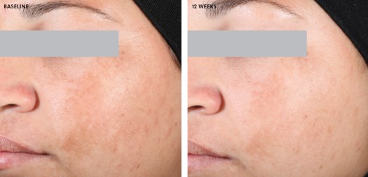 Before and after 12 weeks of using SkinCeuticals Discoloration Defense, showing improved skin tone and reduced dark spots