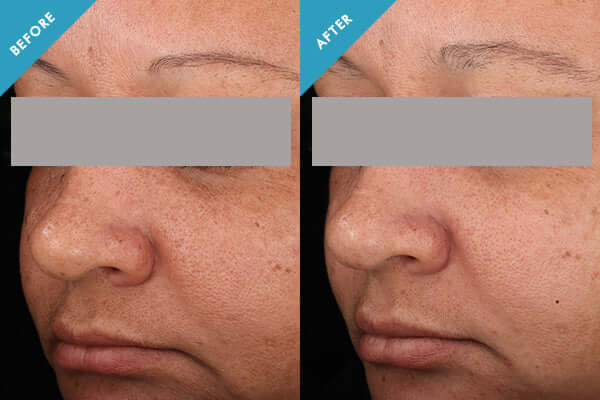 Before and after results showing reduced dark spots and even skin tone from using Skinceuticals Discoloration Defense serum.