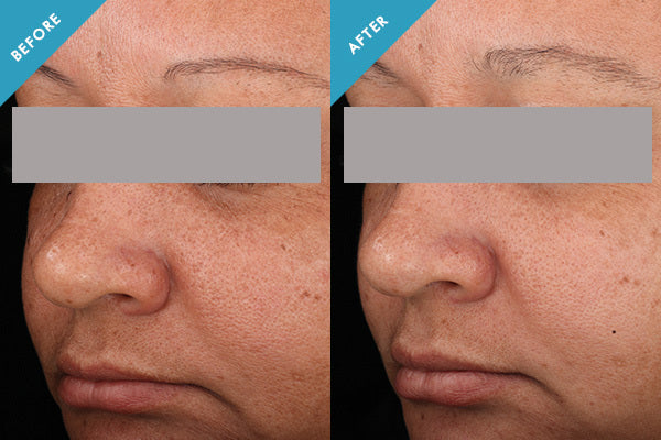 Before and after using SkinCeuticals Discoloration Defense showing reduced dark spots and improved skin tone