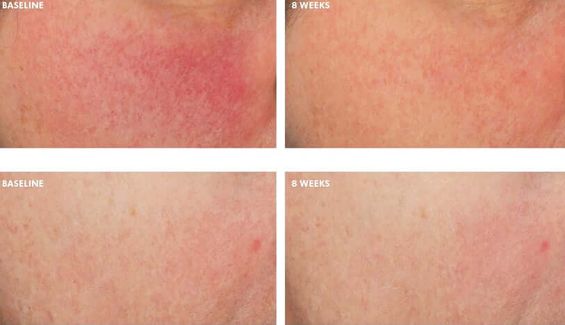 Visible skin improvement comparison at 8 weeks using SkinCeuticals Glycolic 10 Renew Overnight night exfoliating treatment.