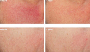 Visible skin improvement comparison at 8 weeks using SkinCeuticals Glycolic 10 Renew Overnight night exfoliating treatment.